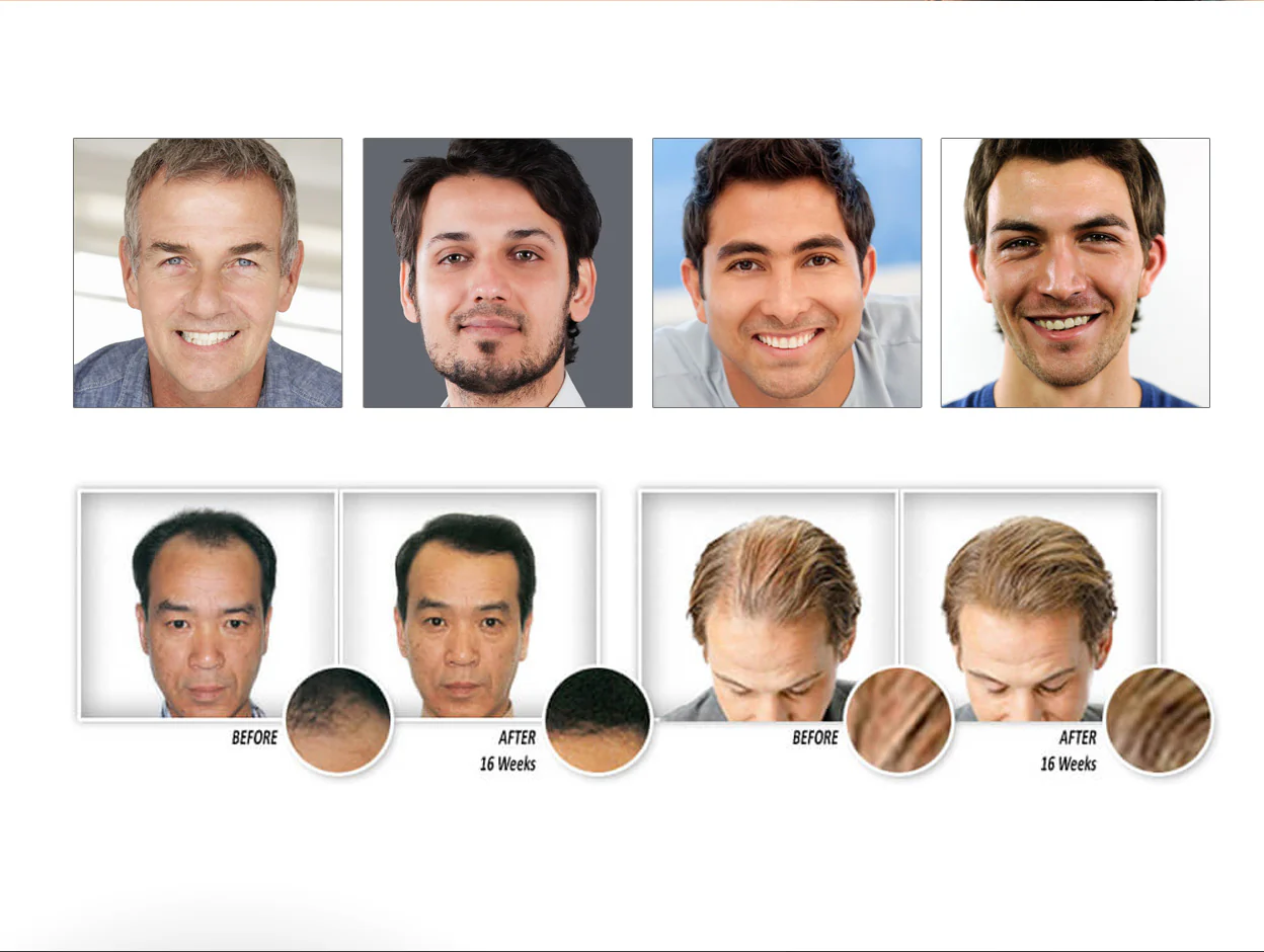 Before and after results showing hair regrowth with Provillus treatment